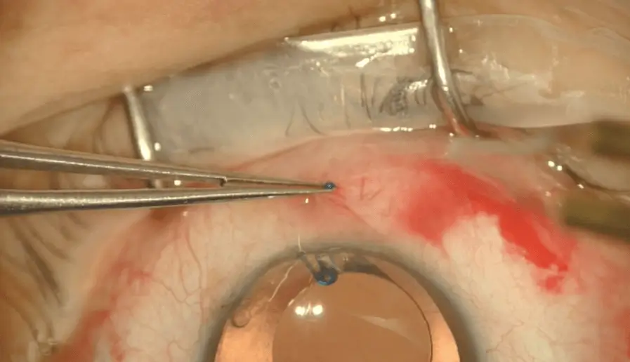 AssiAnchor Surgery Procedure