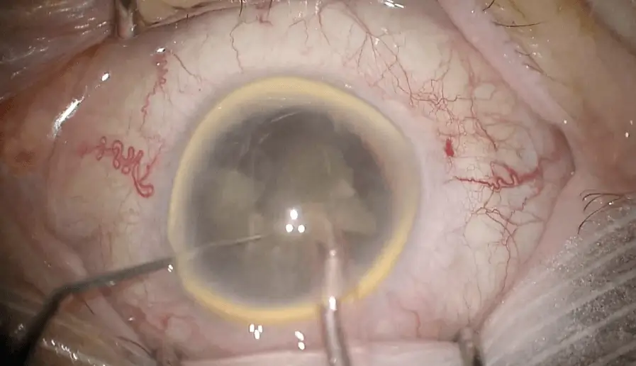 Extend SL Surgery Performed by Dr. Martiano