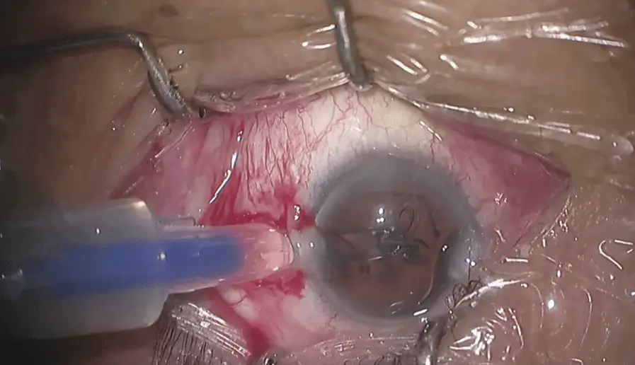 Intensity SL surgery