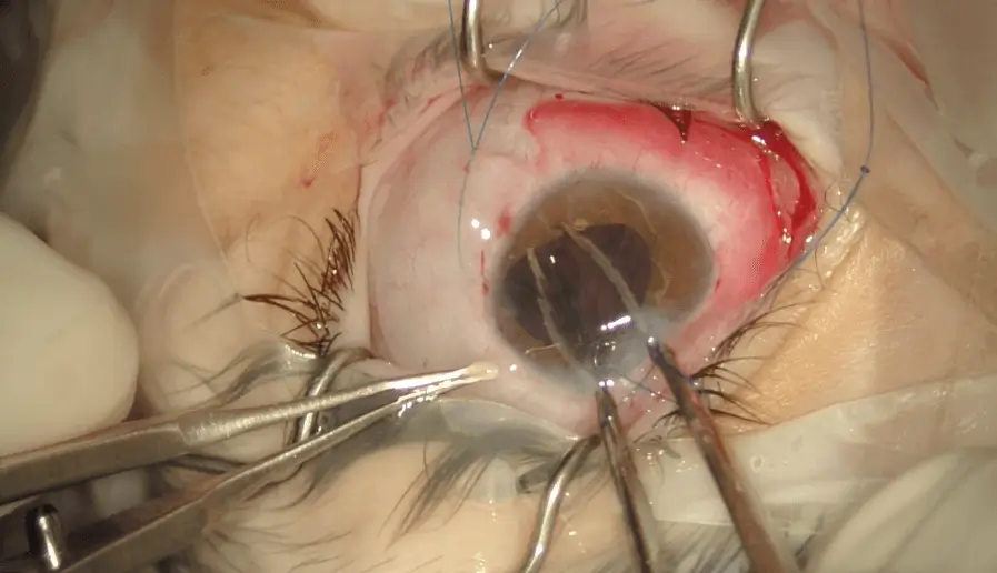 Prof. Assia Performs BunnyLens Scleral Fixation Surgery