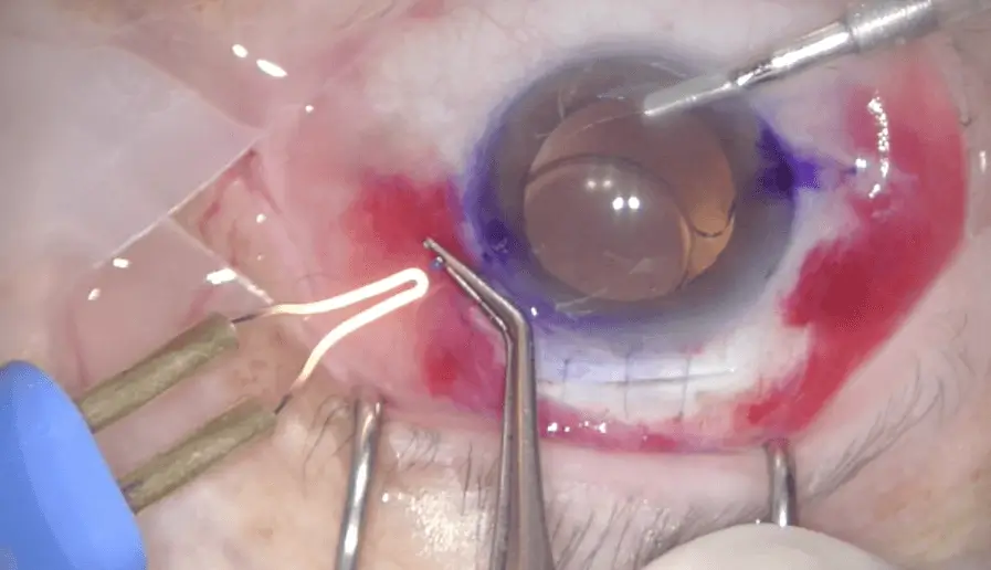 Prof. Assia Performs Scleral Fixation Surgery with SeeLens AF.