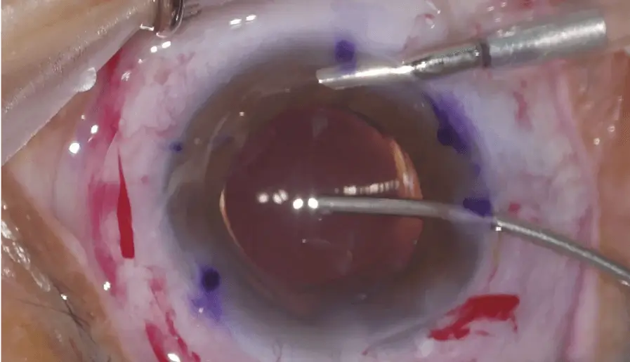 Toric Lens Loading and Surgical Procedure