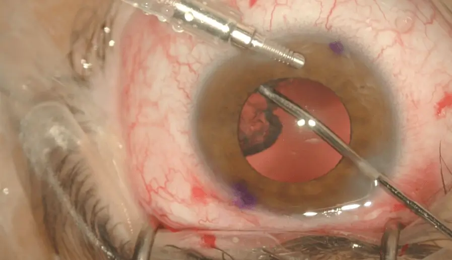 Prof. Assia Performs VisTor Scleral Fixation Surgery.